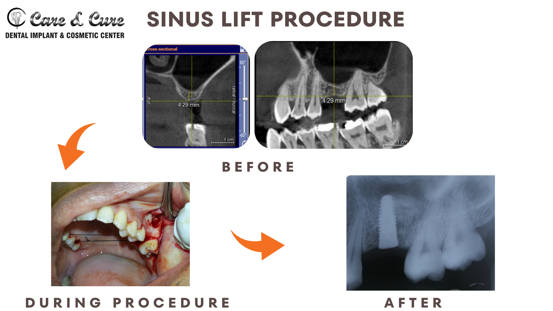 Sinus lift procedure