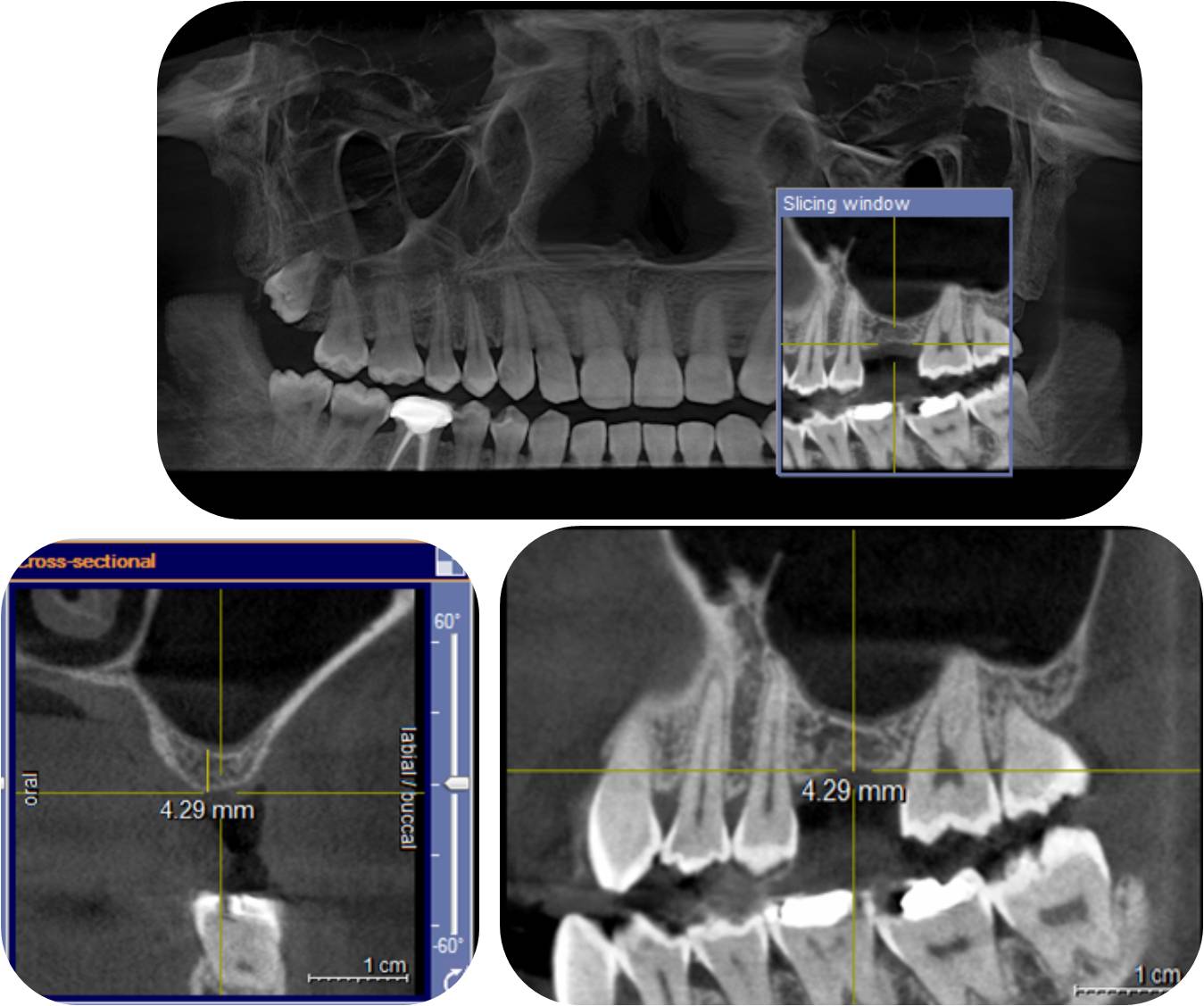 CBCT Scan of Dental Implant
