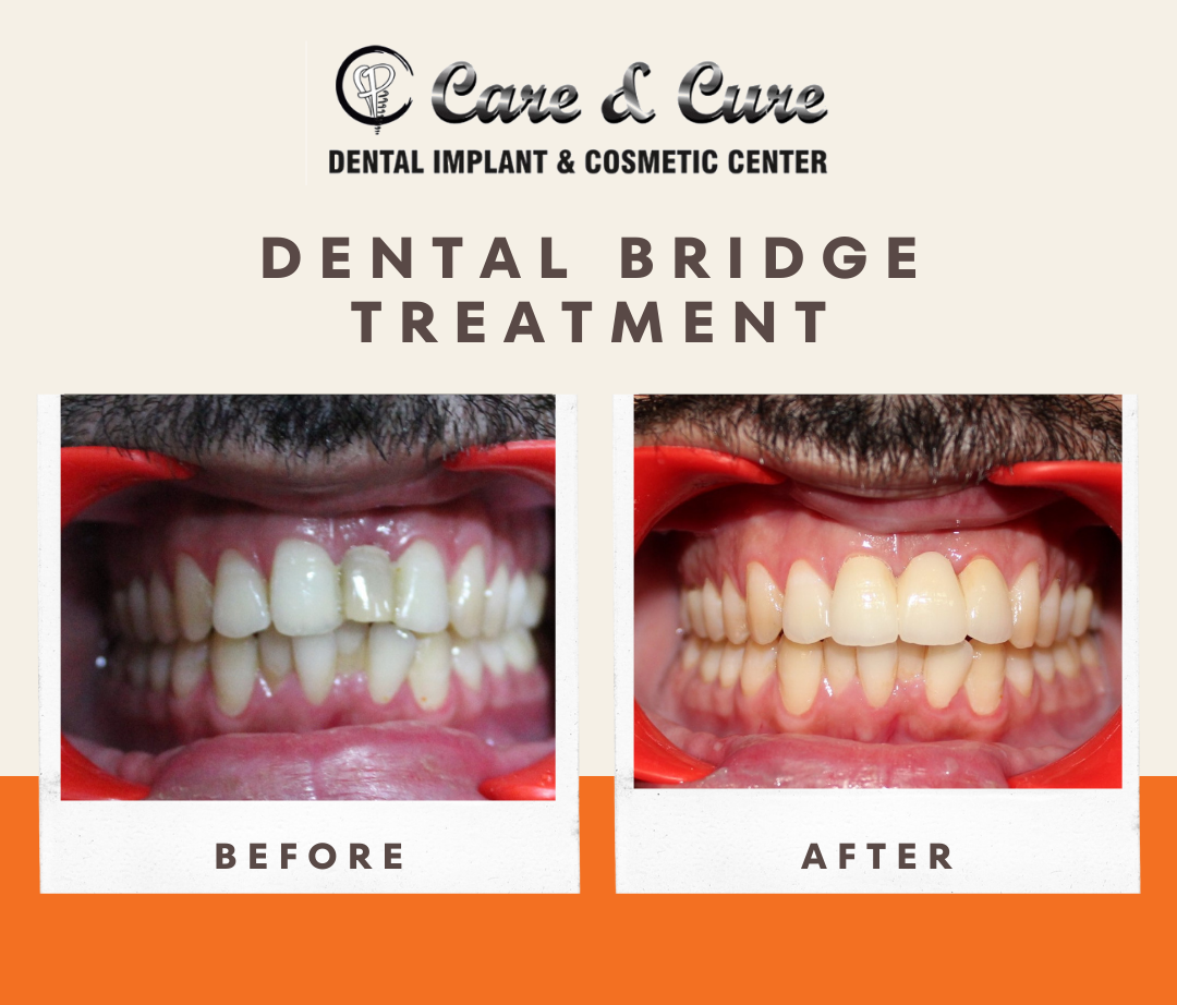 Dental bridge - Before & After