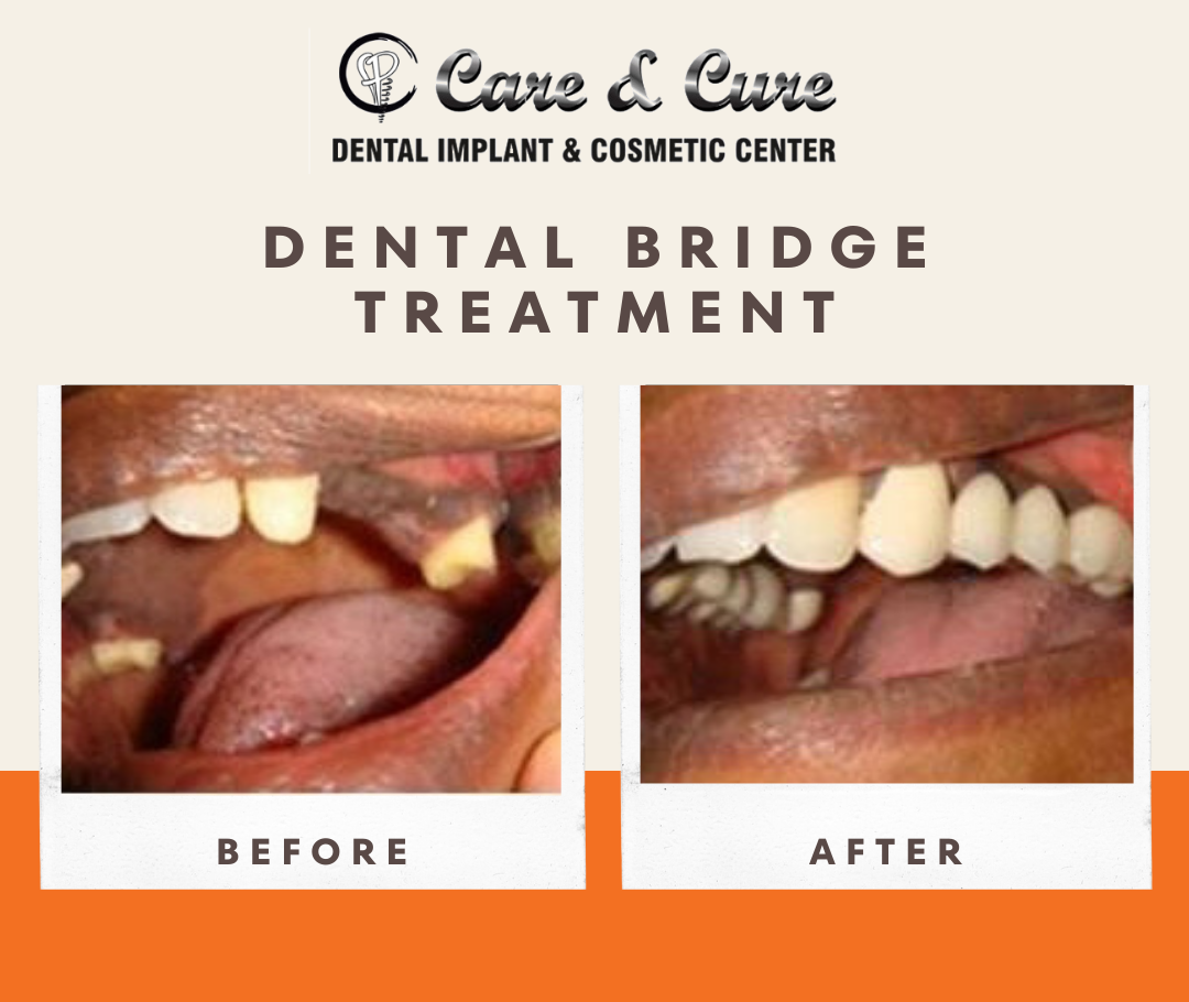 Dental Crown - Before & After