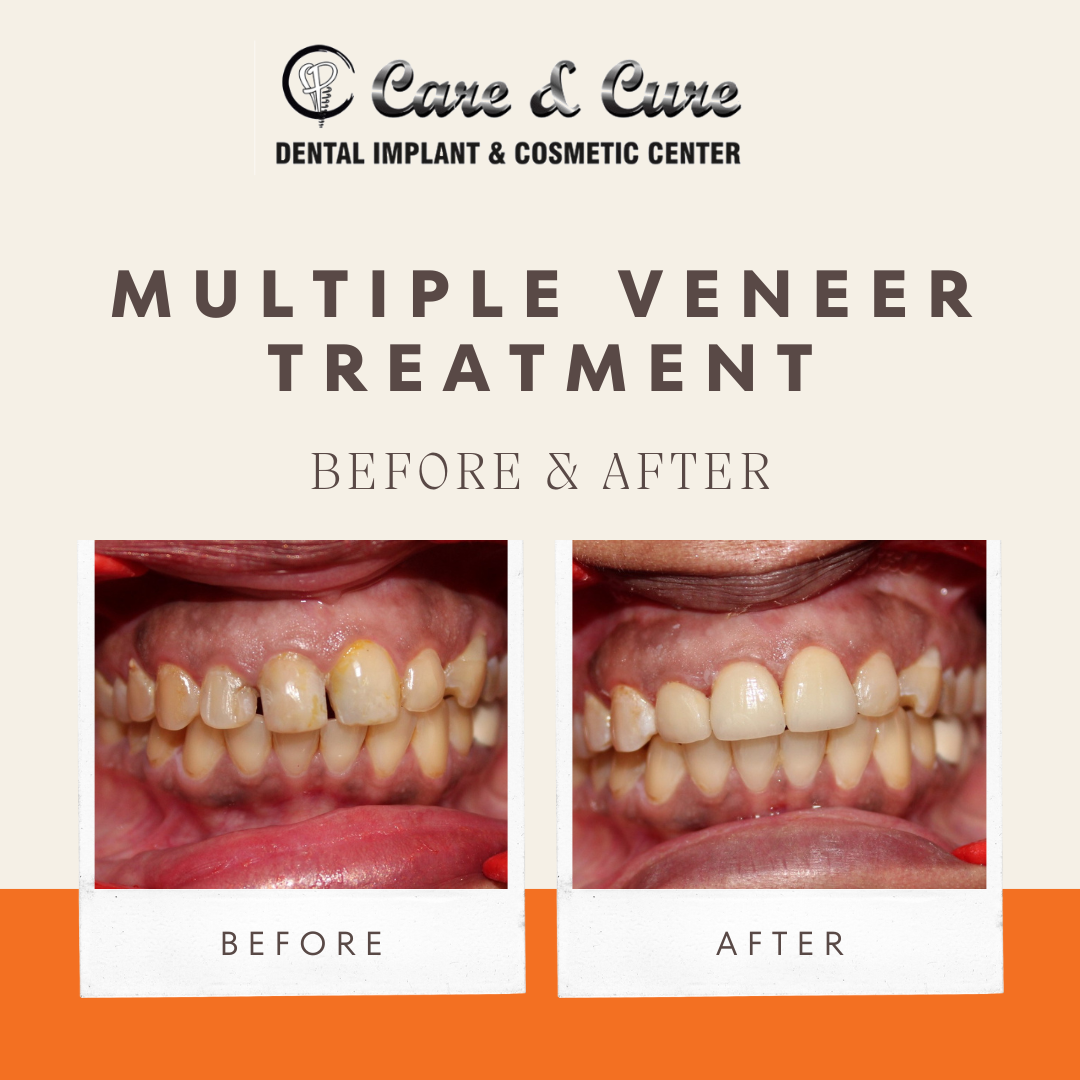 Multiple Veneer Treatment - Before & After