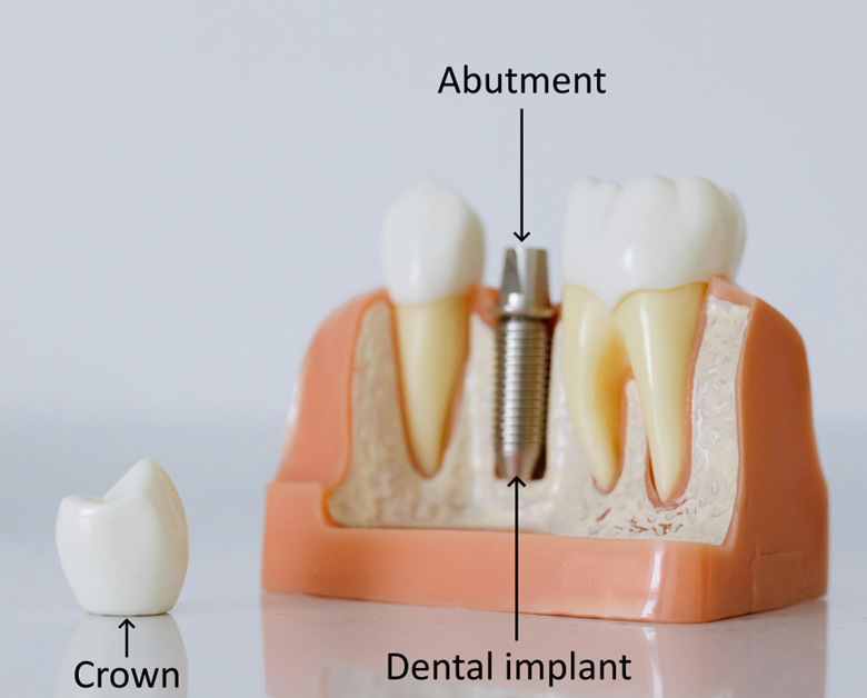 Parts of dental implant