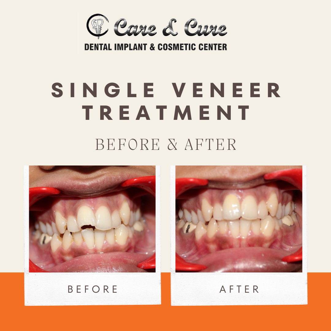 Single Veneer Treatment - Before & After